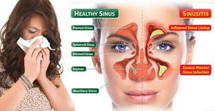 obat herbal sinusitis